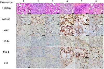 Anastomosing Haemangioma: Report of Three Cases With Molecular and Immunohistochemical Studies and Comparison With Well-Differentiated Angiosarcoma